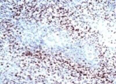 Immunohistological Staining of HIF-1 alpha in Paraffin Embedded Human Glioblastoma Multiforme