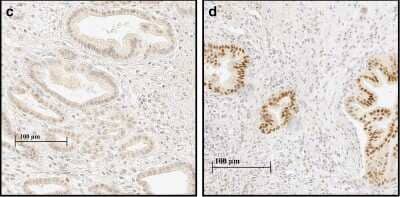 Immunohistological Detection of HIF-1 alpha in PDAC and Adjacent Normal Pancreatic Tissue