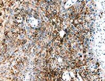 Staining of HIF-1 alpha in Paraffin Embedded Human Throat Cancer