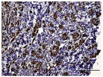 Immunohistological Staining of HIF-1 alpha in Paraffin Embedded Human Kidney Tumor