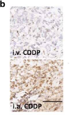 Staining of HIF-1 alpha in i.v. CDDP and i.a. CDDP Administered Tumor Tissue
