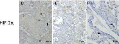 Immunohistological Staining of HIF-2 alpha/EPAS1 in Normal and Diseased Lung Tissue