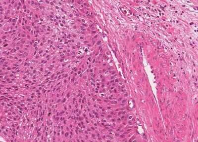 Immunohistochemistry-Paraffin: Human Bladder Tissue MicroArray (Cancer) [NBP3-11846]