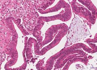 Immunohistochemistry-Paraffin: Human Bladder Tissue MicroArray (Cancer) [NBP3-11846]