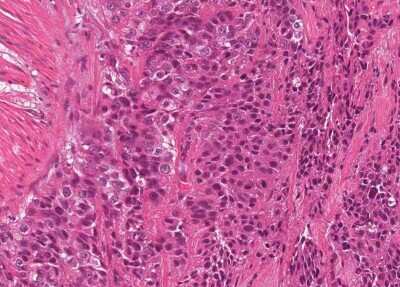 Immunohistochemistry-Paraffin: Human Bladder Tissue MicroArray (Cancer) [NBP3-11846]