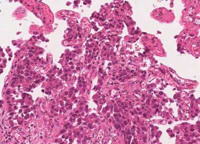 Immunohistochemistry-Paraffin: Human Bladder Tissue MicroArray (Cancer) [NBP3-11846]