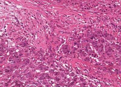 Immunohistochemistry-Paraffin: Human Bladder Tissue MicroArray (Cancer) [NBP3-11846]