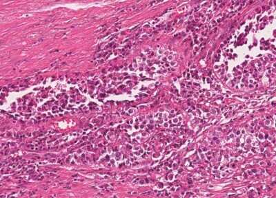 Immunohistochemistry-Paraffin: Human Bladder Tissue MicroArray (Cancer) [NBP3-11846]
