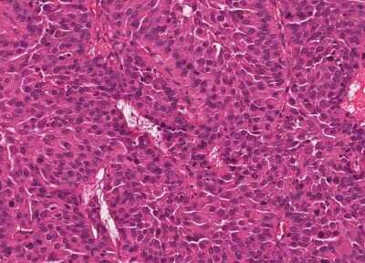 Immunohistochemistry-Paraffin: Human Bladder Tissue MicroArray (Cancer) [NBP3-11846]