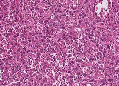 Immunohistochemistry-Paraffin: Human Bladder Tissue MicroArray (Cancer) [NBP3-11846]