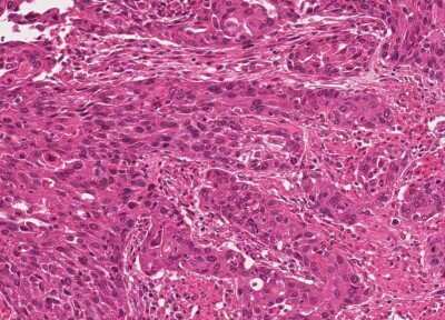 Immunohistochemistry-Paraffin: Human Bladder Tissue MicroArray (Cancer) [NBP3-11846]