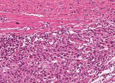 Immunohistochemistry-Paraffin: Human Bladder Tissue MicroArray (Cancer) [NBP3-11846]