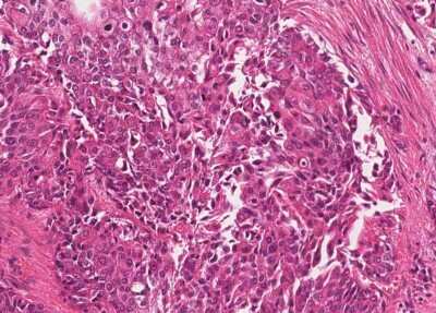 Immunohistochemistry-Paraffin: Human Bladder Tissue MicroArray (Cancer) [NBP3-11846]