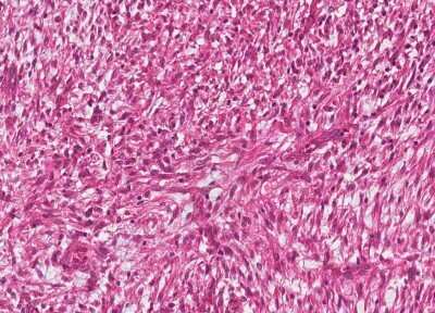 Immunohistochemistry-Paraffin: Human Bladder Tissue MicroArray (Cancer) [NBP3-11846]