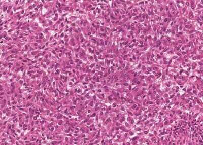 Immunohistochemistry-Paraffin: Human Bladder Tissue MicroArray (Cancer) [NBP3-11846]