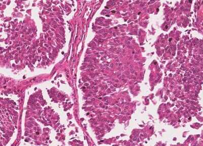 Immunohistochemistry-Paraffin: Human Bladder Tissue MicroArray (Cancer) [NBP3-11846]