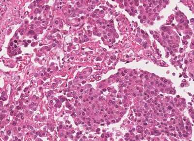 Immunohistochemistry-Paraffin: Human Bladder Tissue MicroArray (Cancer) [NBP3-11846]