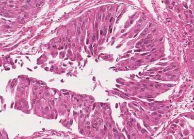 Immunohistochemistry-Paraffin: Human Bladder Tissue MicroArray (Cancer) [NBP3-11846]