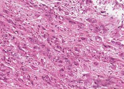 Immunohistochemistry-Paraffin: Human Bladder Tissue MicroArray (Cancer) [NBP3-11846]