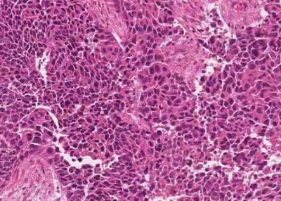 Immunohistochemistry-Paraffin: Human Bladder Tissue MicroArray (Cancer) [NBP3-11846]