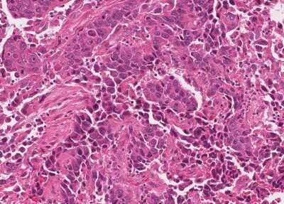 Immunohistochemistry-Paraffin: Human Bladder Tissue MicroArray (Cancer) [NBP3-11846]