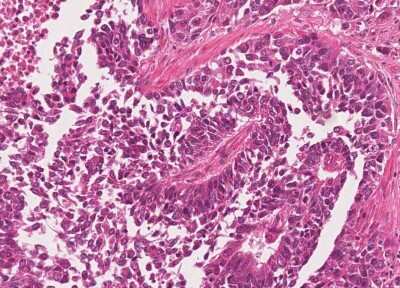 Immunohistochemistry-Paraffin: Human Bladder Tissue MicroArray (Cancer) [NBP3-11846]
