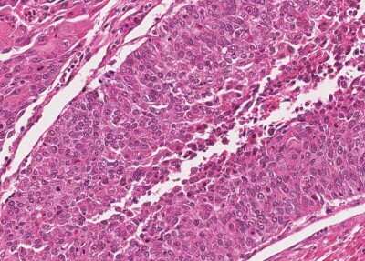 Immunohistochemistry-Paraffin: Human Bladder Tissue MicroArray (Cancer) [NBP3-11846]