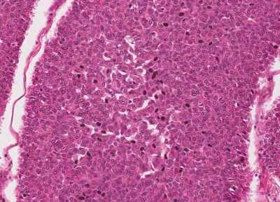 Immunohistochemistry-Paraffin: Human Bladder Tissue MicroArray (Cancer) [NBP3-11846]