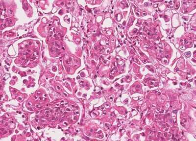 Immunohistochemistry-Paraffin: Human Bladder Tissue MicroArray (Cancer) [NBP3-11846]
