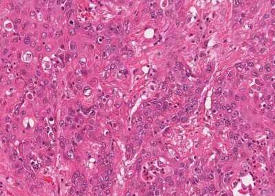 Immunohistochemistry-Paraffin: Human Bladder Tissue MicroArray (Cancer) [NBP3-11846]