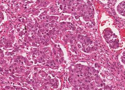 Immunohistochemistry-Paraffin: Human Bladder Tissue MicroArray (Cancer) [NBP3-11846]