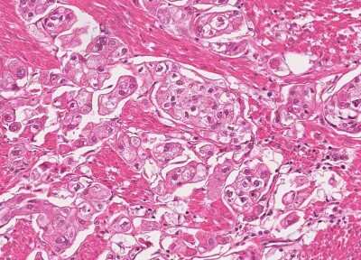 Immunohistochemistry-Paraffin: Human Bladder Tissue MicroArray (Cancer) [NBP3-11846]