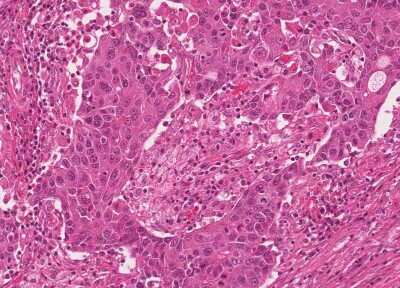 Immunohistochemistry-Paraffin: Human Bladder Tissue MicroArray (Cancer) [NBP3-11846]