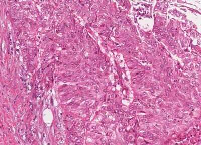 Immunohistochemistry-Paraffin: Human Bladder Tissue MicroArray (Cancer) [NBP3-11846]