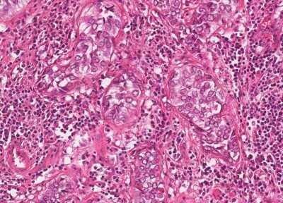 Immunohistochemistry-Paraffin: Human Bladder Tissue MicroArray (Cancer) [NBP3-11846]