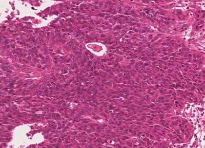 Immunohistochemistry-Paraffin: Human Bladder Tissue MicroArray (Cancer) [NBP3-11846]