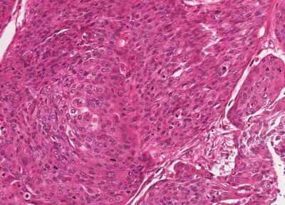 Immunohistochemistry-Paraffin: Human Bladder Tissue MicroArray (Cancer) [NBP3-11846]