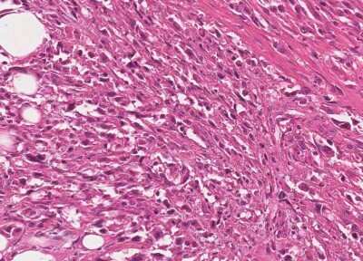 Immunohistochemistry-Paraffin: Human Bladder Tissue MicroArray (Cancer) [NBP3-11846]