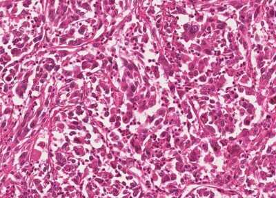 Immunohistochemistry-Paraffin: Human Bladder Tissue MicroArray (Cancer) [NBP3-11846]