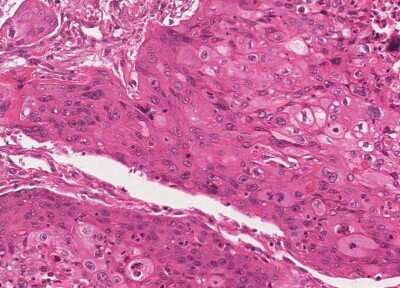 Immunohistochemistry-Paraffin: Human Bladder Tissue MicroArray (Cancer) [NBP3-11846]