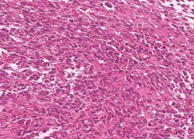 Immunohistochemistry-Paraffin: Human Bladder Tissue MicroArray (Cancer) [NBP3-11846]