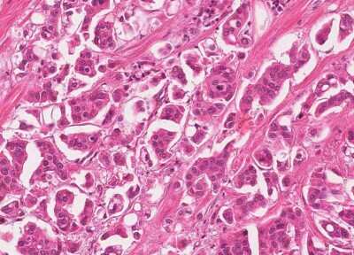 Immunohistochemistry-Paraffin: Human Bladder Tissue MicroArray (Cancer) [NBP3-11846]