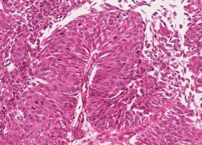 Immunohistochemistry-Paraffin: Human Bladder Tissue MicroArray (Cancer) [NBP3-11846]