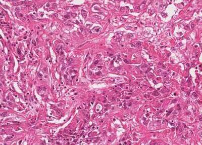 Immunohistochemistry-Paraffin: Human Bladder Tissue MicroArray (Cancer) [NBP3-11846]