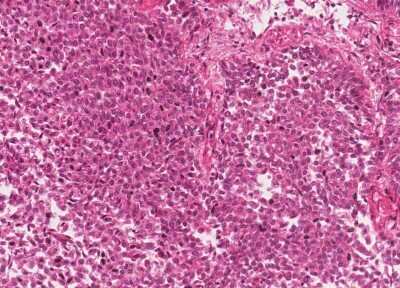 Immunohistochemistry-Paraffin: Human Bladder Tissue MicroArray (Cancer) [NBP3-11846]
