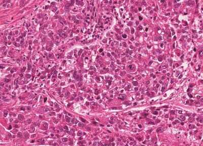 Immunohistochemistry-Paraffin: Human Bladder Tissue MicroArray (Cancer) [NBP3-11846]