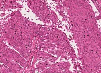 Immunohistochemistry-Paraffin: Human Bladder Tissue MicroArray (Cancer) [NBP3-11846]