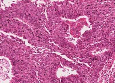 Immunohistochemistry-Paraffin: Human Bladder Tissue MicroArray (Cancer) [NBP3-11846]