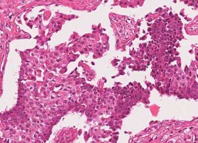 Immunohistochemistry-Paraffin: Human Bladder Tissue MicroArray (Cancer) [NBP3-11846]