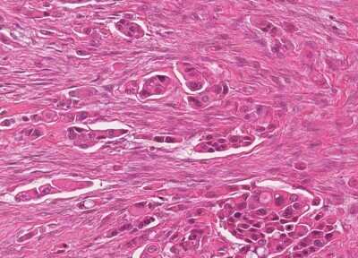 Immunohistochemistry-Paraffin: Human Bladder Tissue MicroArray (Cancer) [NBP3-11846]